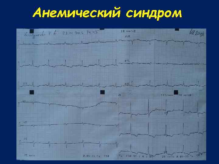 Анемический синдром 