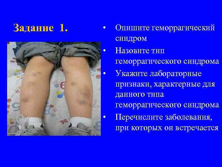 Задание 1. • • Опишите геморрагический синдром Назовите тип геморрагического синдрома Укажите лабораторные признаки,