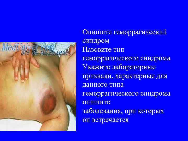 Опишите геморрагический синдром Назовите тип геморрагического синдрома Укажите лабораторные признаки, характерные для данного типа