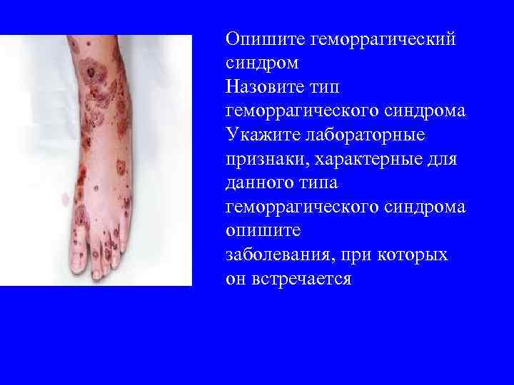 Опишите геморрагический синдром Назовите тип геморрагического синдрома Укажите лабораторные признаки, характерные для данного типа