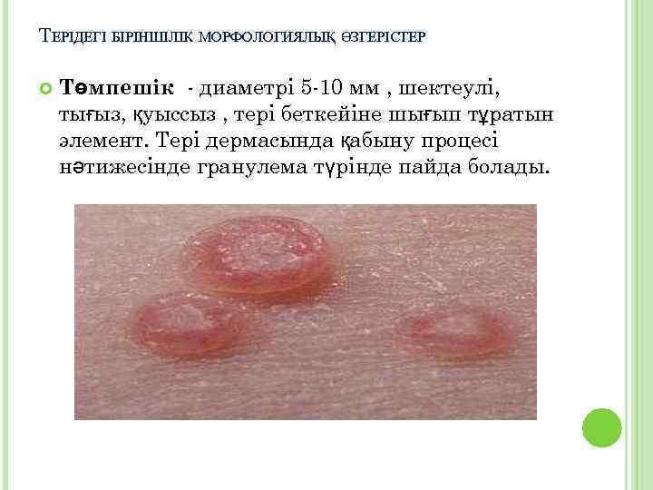 ТЕРІДЕГІ БІРІНШІЛІК МОРФОЛОГИЯЛЫҚ ӨЗГЕРІСТЕР Төмпешік - диаметрі 5 -10 мм , шектеулі, тығыз, қуыссыз