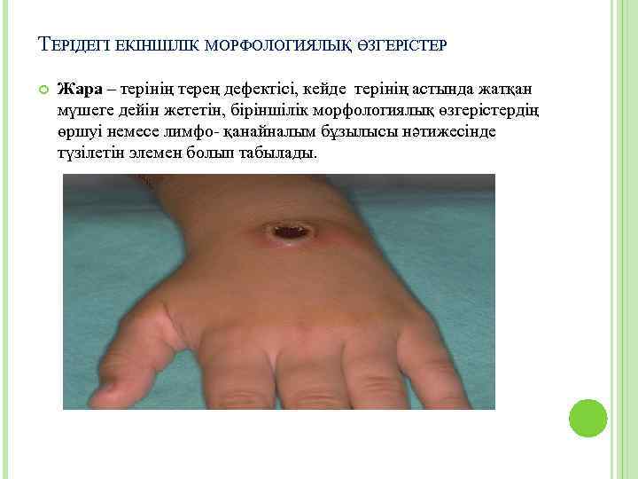 ТЕРІДЕГІ ЕКІНШІЛІК МОРФОЛОГИЯЛЫҚ ӨЗГЕРІСТЕР Жара – терінің терең дефектісі, кейде терінің астында жатқан мүшеге