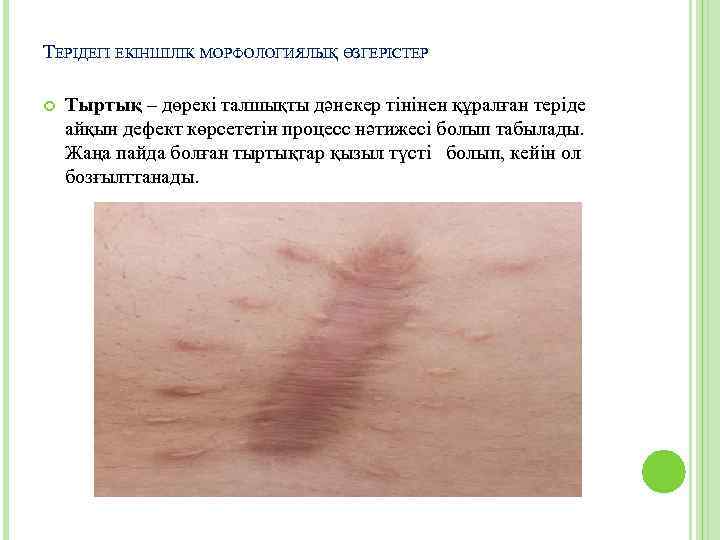 ТЕРІДЕГІ ЕКІНШІЛІК МОРФОЛОГИЯЛЫҚ ӨЗГЕРІСТЕР Тыртық – дөрекі талшықты дәнекер тінінен құралған теріде айқын дефект