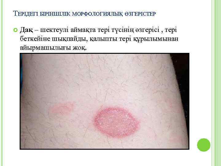 ТЕРІДЕГІ БІРІНШІЛІК МОРФОЛОГИЯЛЫҚ ӨЗГЕРІСТЕР Дақ – шектеулі аймақта тері түсінің өзгерісі , тері беткейіне