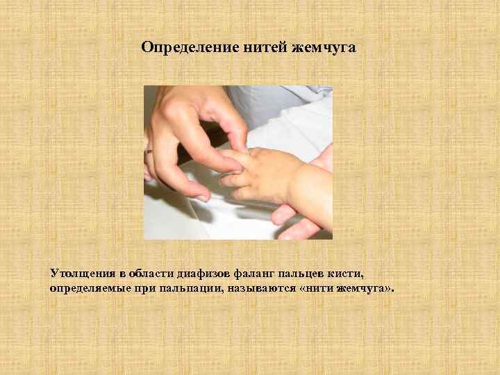 Определение нитей жемчуга Утолщения в области диафизов фаланг пальцев кисти, определяемые при пальпации, называются