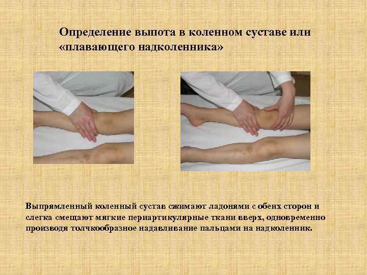 Определение выпота в коленном суставе или «плавающего надколенника» Выпрямленный коленный сустав сжимают ладонями с