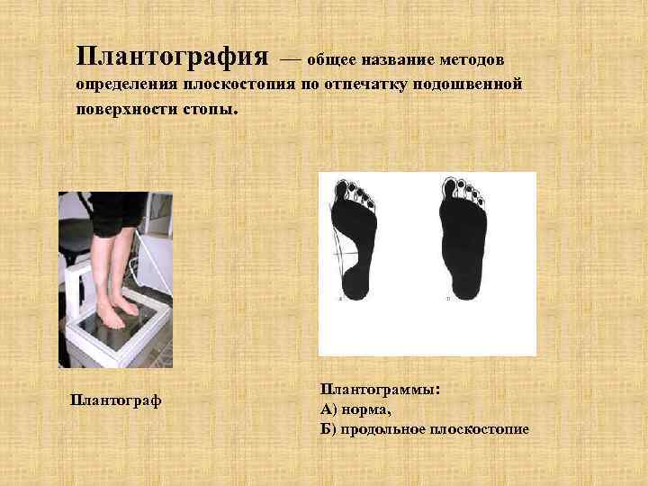 Плантография — общее название методов определения плоскостопия по отпечатку подошвенной поверхности стопы. Плантограф Плантограммы: