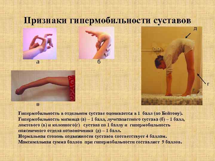 Признаки гипермобильности суставов а д б г в Гипермобильность в отдельном суставе оценивается в