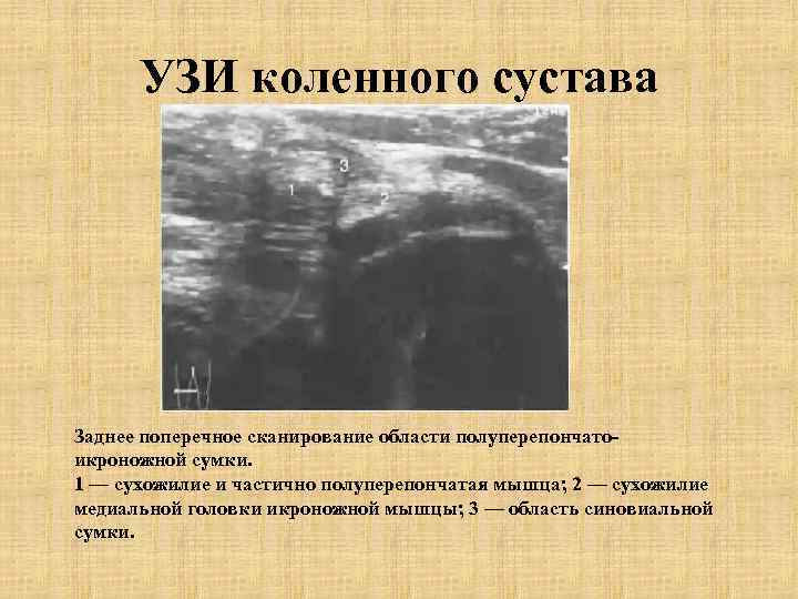 УЗИ коленного сустава Заднее поперечное сканирование области полуперепончатоикроножной сумки. 1 — сухожилие и частично