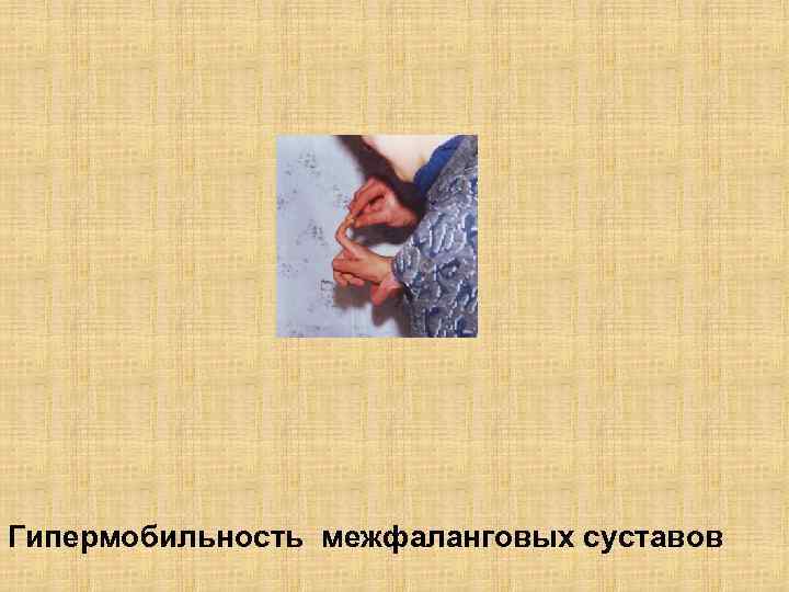 Гипермобильность межфаланговых суставов 