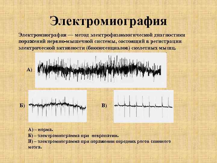Электромиография — метод электрофизиологической диагностики поражений нервно-мышечной системы, состоящий в регистрации электрической активности (биопотенциалов)