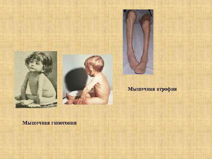 Мышечная атрофия Мышечная гипотония 