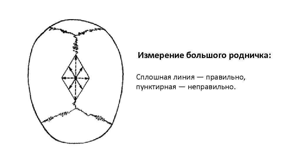 Измерение большого родничка: Сплошная линия — правильно, пунктирная — неправильно. 