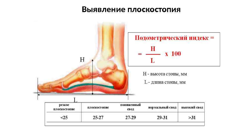 Выявление плоскостопия 