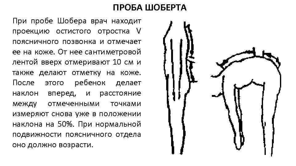 ПРОБА ШОБЕРТА При пробе Шобера врач находит проекцию остистого отростка V поясничного позвонка и