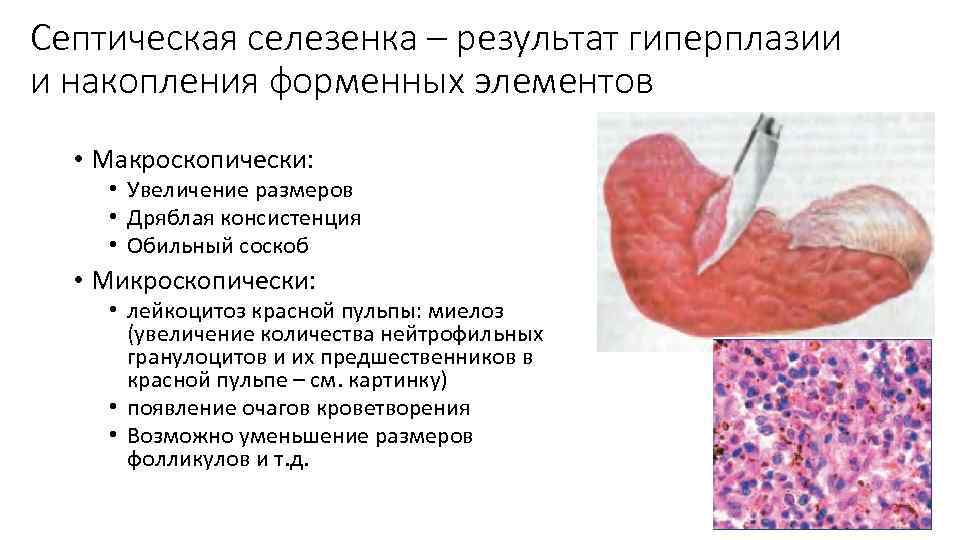 Септическая селезенка – результат гиперплазии и накопления форменных элементов • Макроскопически: • Увеличение размеров