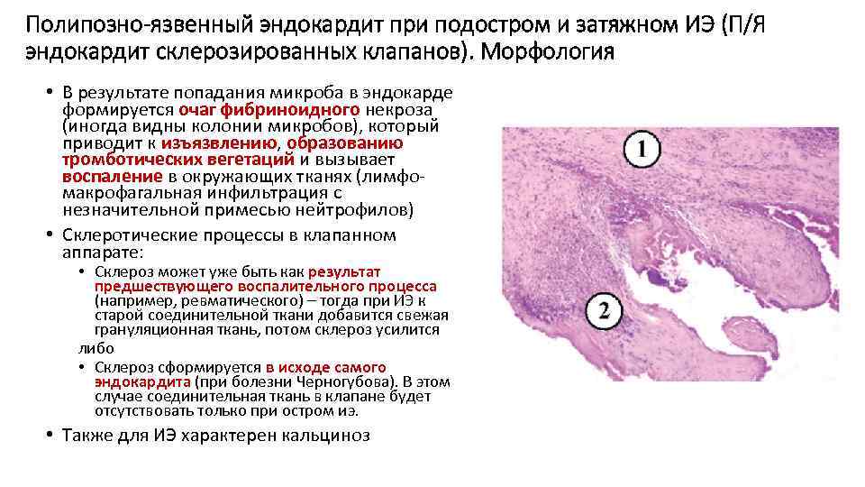 Полипозно-язвенный эндокардит при подостром и затяжном ИЭ (П/Я эндокардит склерозированных клапанов). Морфология • В