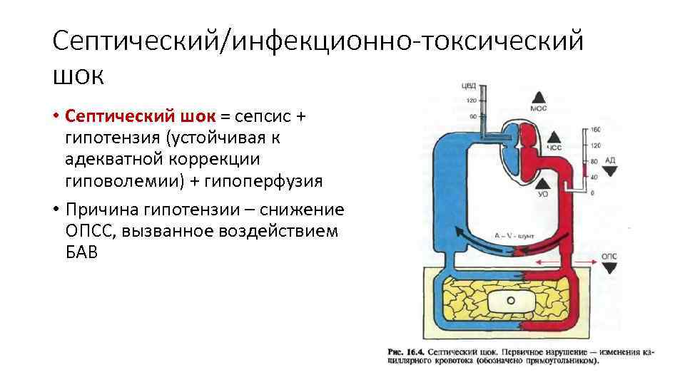 Септический/инфекционно-токсический шок • Септический шок = сепсис + гипотензия (устойчивая к адекватной коррекции гиповолемии)