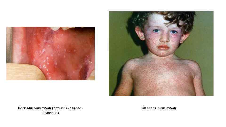 Коревая энантема (пятна Филатова. Коплика) Коревая экзантема 