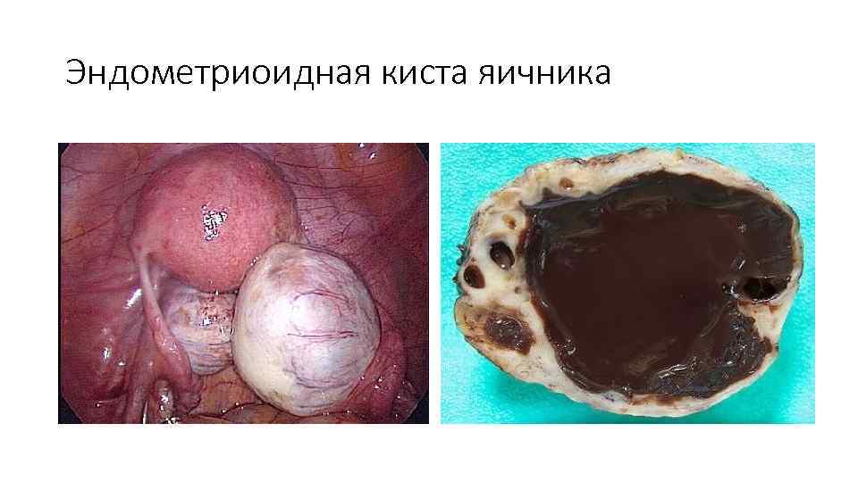 Эндометриоидная киста яичника 