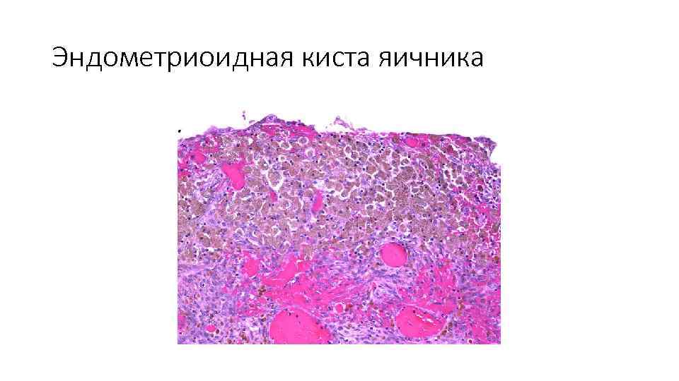 Эндометриоидная киста яичника 