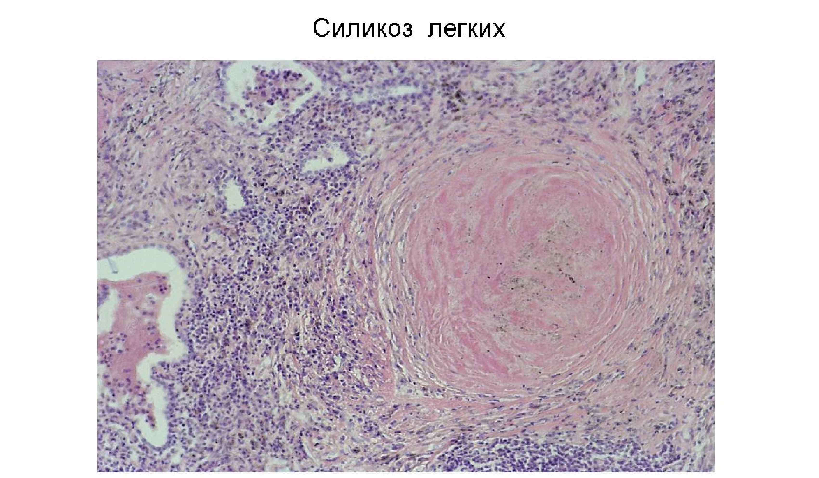 Силикоз легкого патанатомия