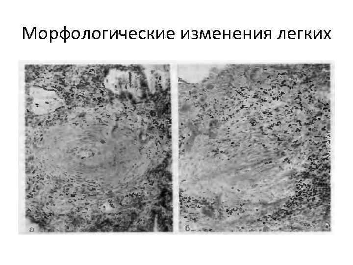 Морфологические изменения легких 