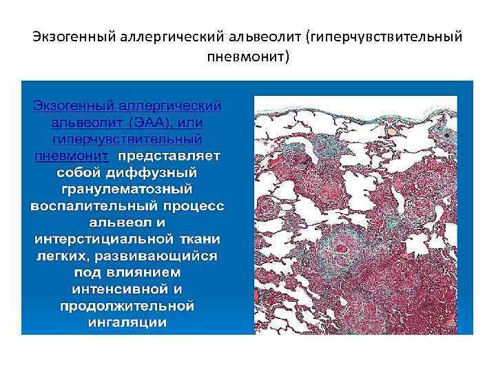 Экзогенный аллергический альвеолит (гиперчувствительный пневмонит) 