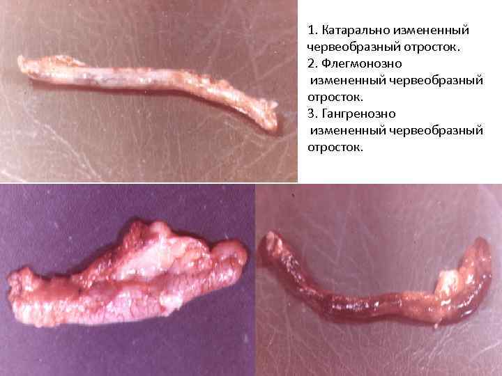 1. Катарально измененный червеобразный отросток. 2. Флегмонозно измененный червеобразный отросток. 3. Гангренозно измененный червеобразный