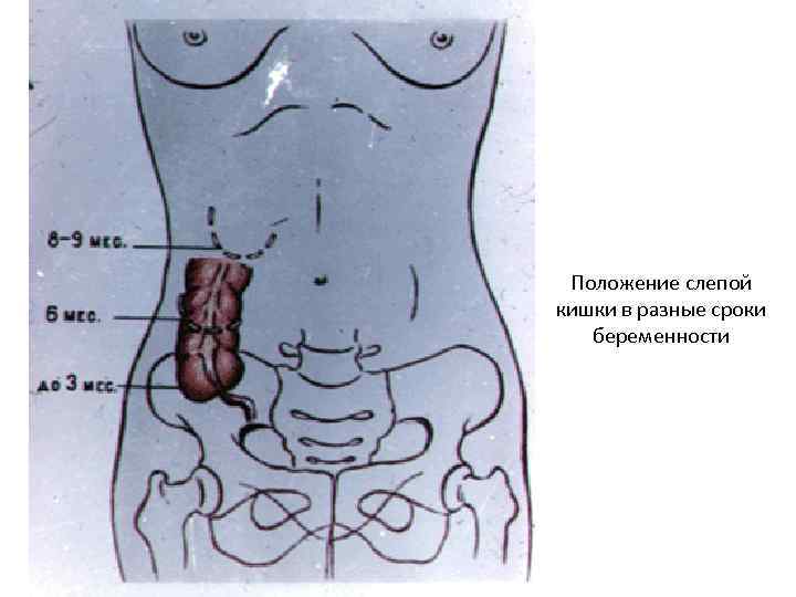 Положение слепой кишки в разные сроки беременности 