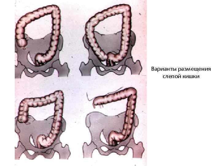Варианты размещения слепой кишки 