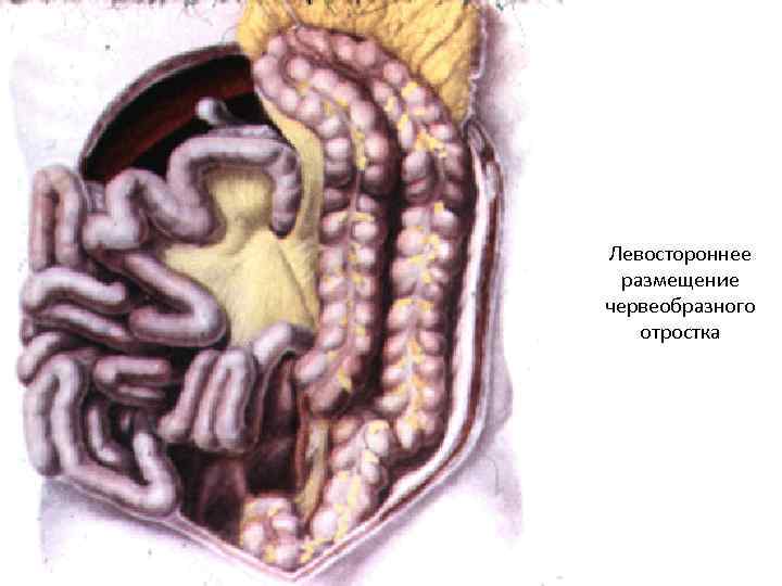 Левостороннее размещение червеобразного отростка 