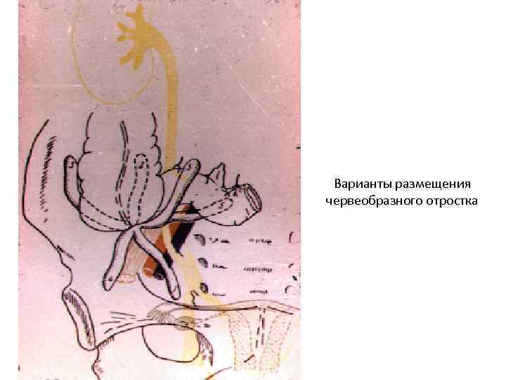 Варианты размещения червеобразного отростка 