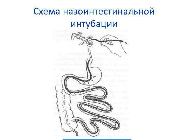 Схема назоинтестинальной интубации 