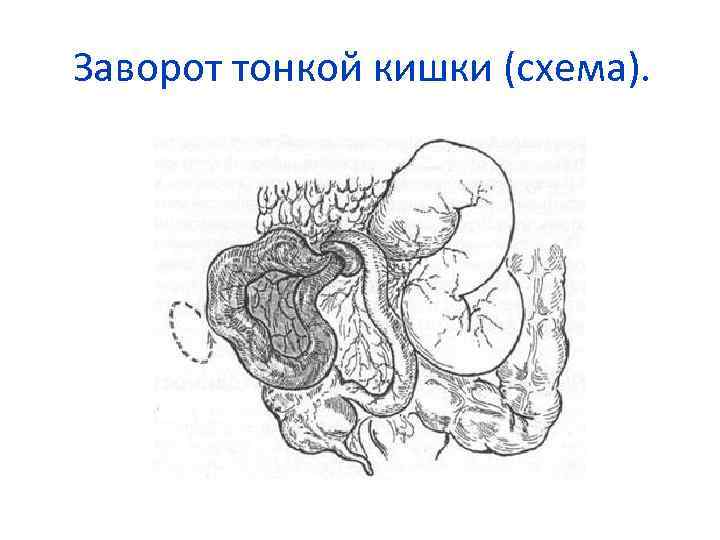 Заворот тонкой кишки (схема). 