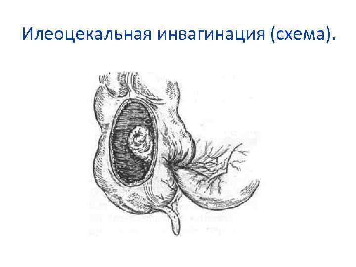 Илеоцекальная инвагинация (схема). 