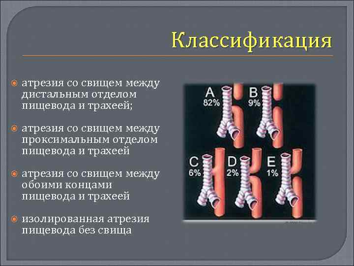 Классификация атрезия со свищем между дистальным отделом пищевода и трахеей; атрезия со свищем между