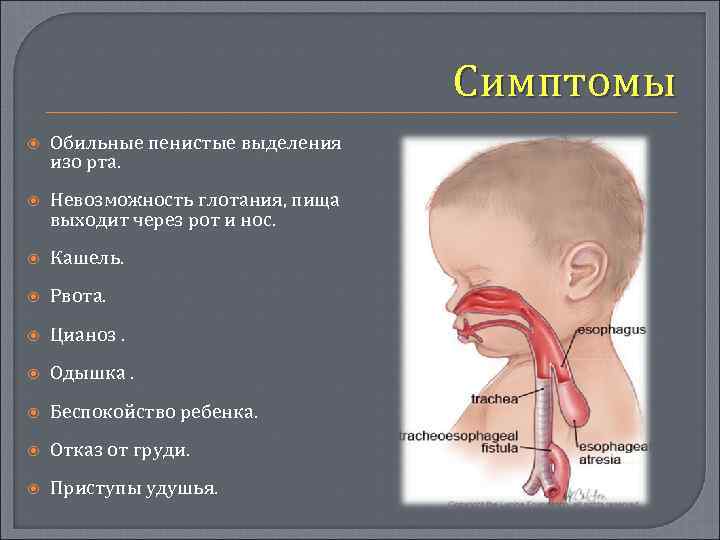 Симптомы Обильные пенистые выделения изо рта. Невозможность глотания, пища выходит через рот и нос.