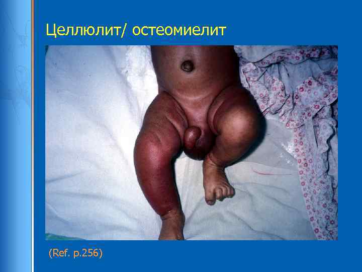 Целлюлит/ остеомиелит (Ref. p. 256) 