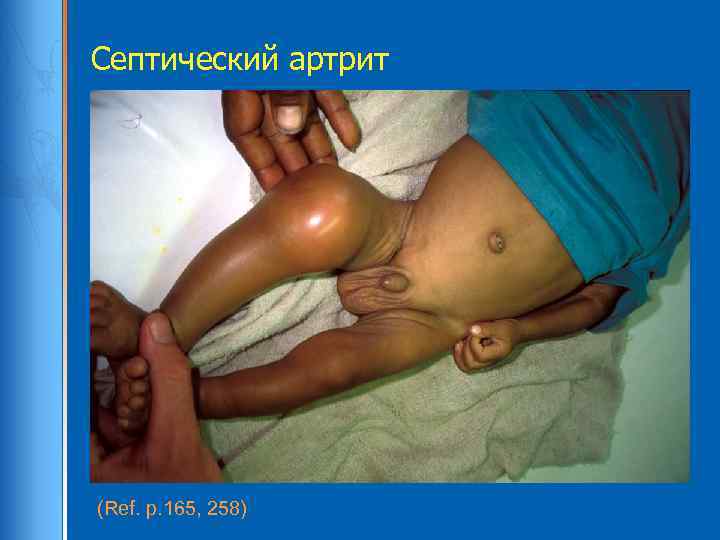 Септический артрит (Ref. p. 165, 258) 
