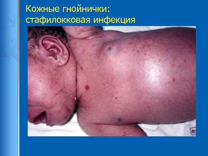 Кожные гнойнички: стафилокковая инфекция 
