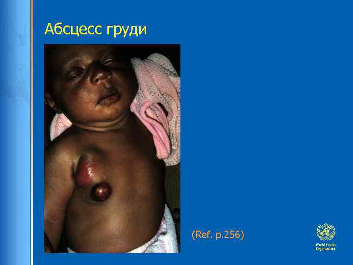 Абсцесс груди (Ref. p. 256) 