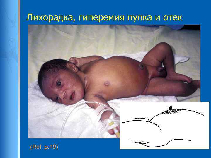 Лихорадка, гиперемия пупка и отек (Ref. p. 49) 