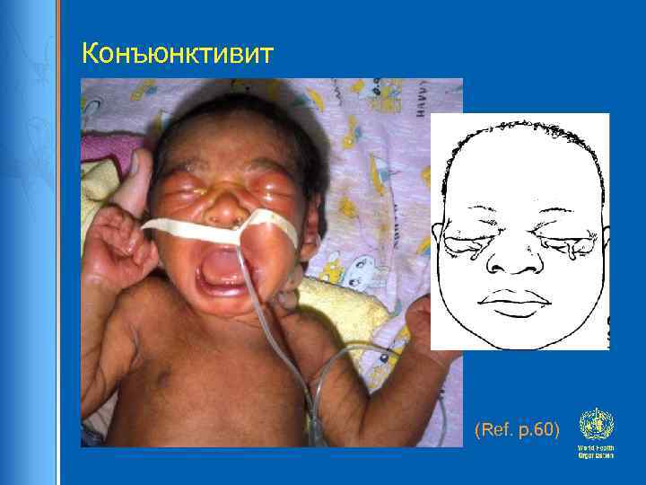 Конъюнктивит (Ref. p. 60) 