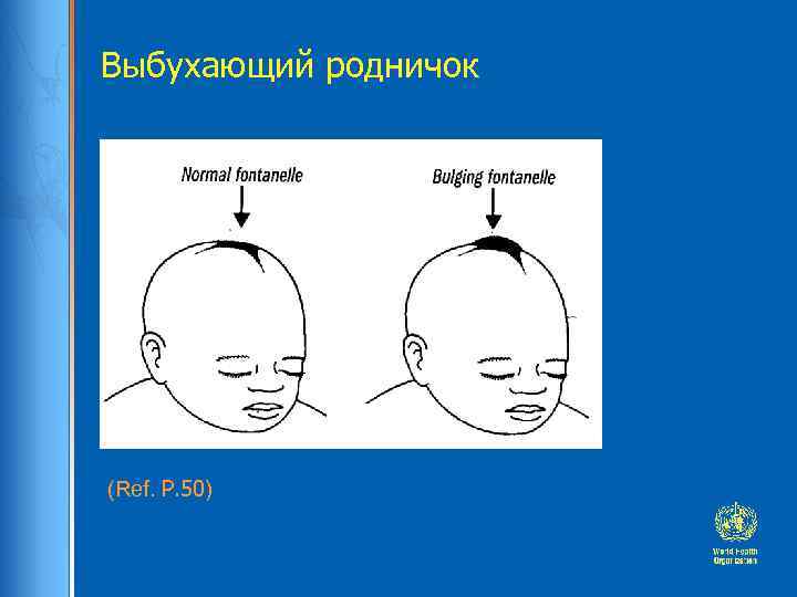 Выбухающий родничок (Ref. P. 50) 