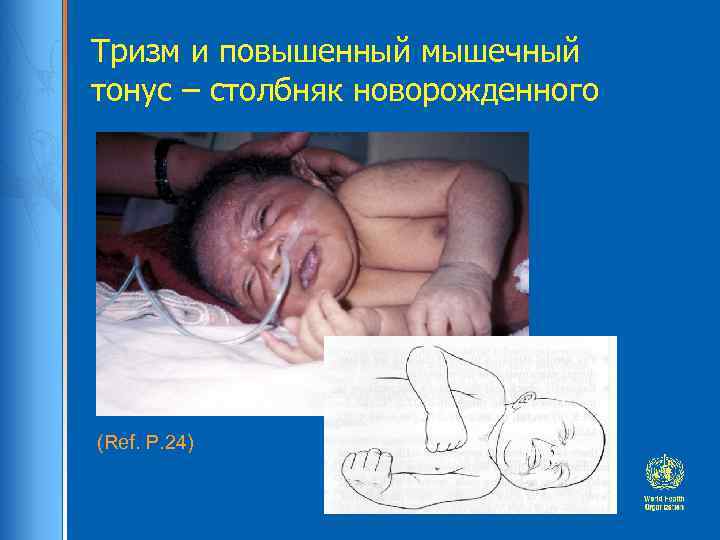 Тризм и повышенный мышечный тонус – столбняк новорожденного (Ref. P. 24) 