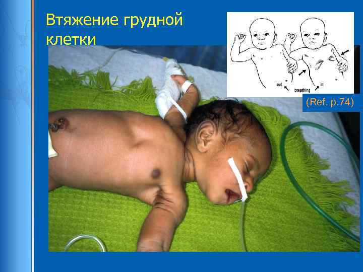 Втяжение грудной клетки (Ref. p. 74) 
