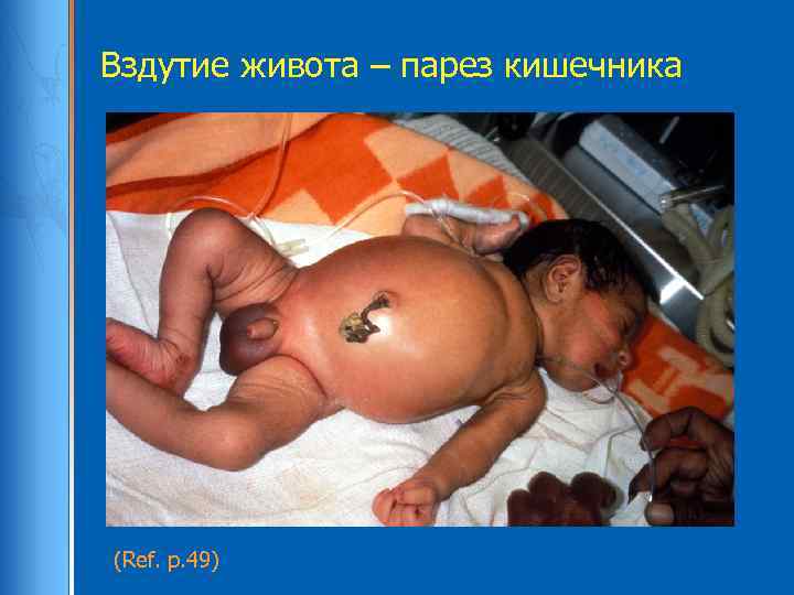 Вздутие живота – парез кишечника (Ref. p. 49) 