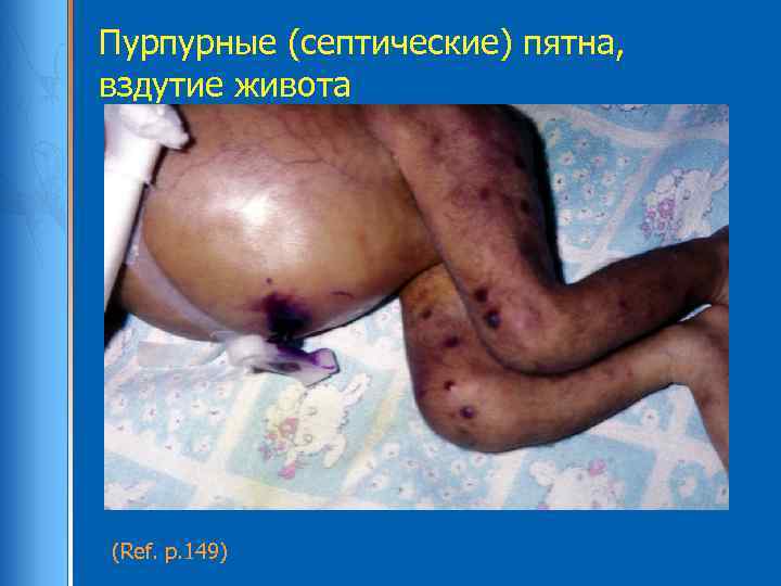 Пурпурные (септические) пятна, вздутие живота (Ref. p. 149) 