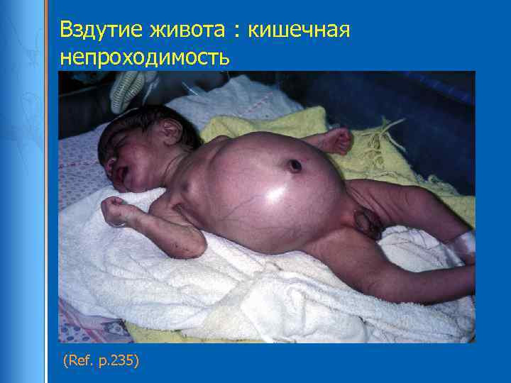 Вздутие живота : кишечная непроходимость (Ref. p. 235) 